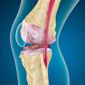 Excessive tension of the thigh muscle causes knee pain