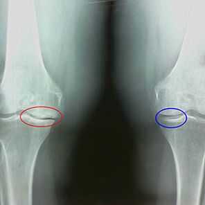 Knee articulation arthrosis on radiography