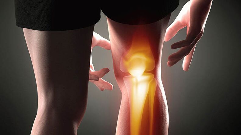 Knee articulation arthrosis