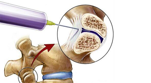 Paravertebral block for back pain
